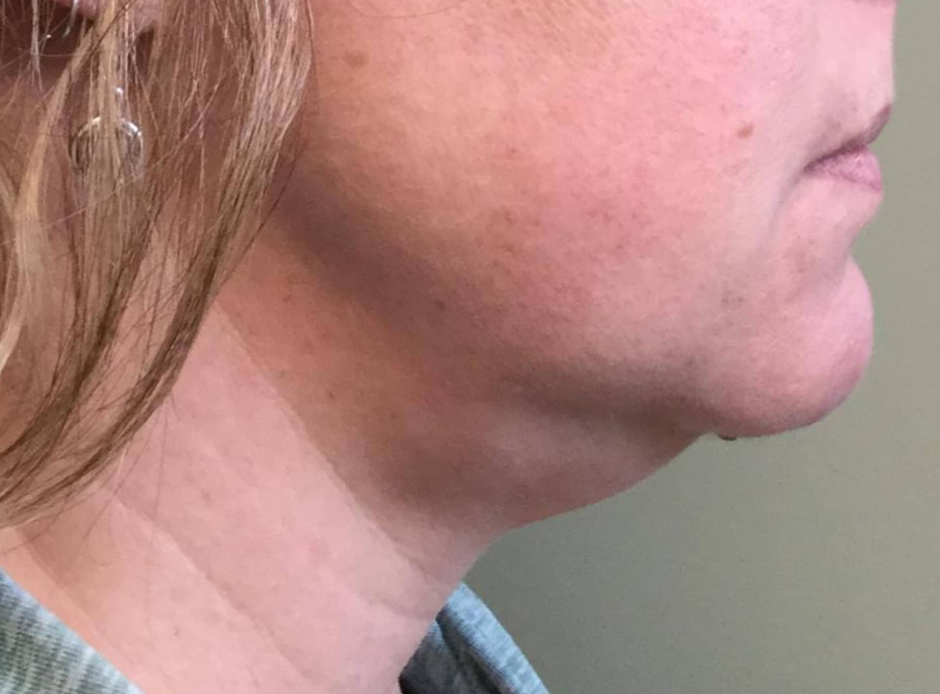 John Reilly MD Plastic Surgeon liposuction result — Bedford, NH