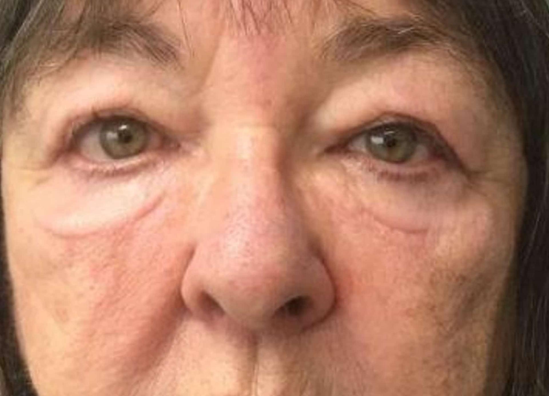 John Reilly MD Plastic Surgeon eyelid lift result — Bedford, NH