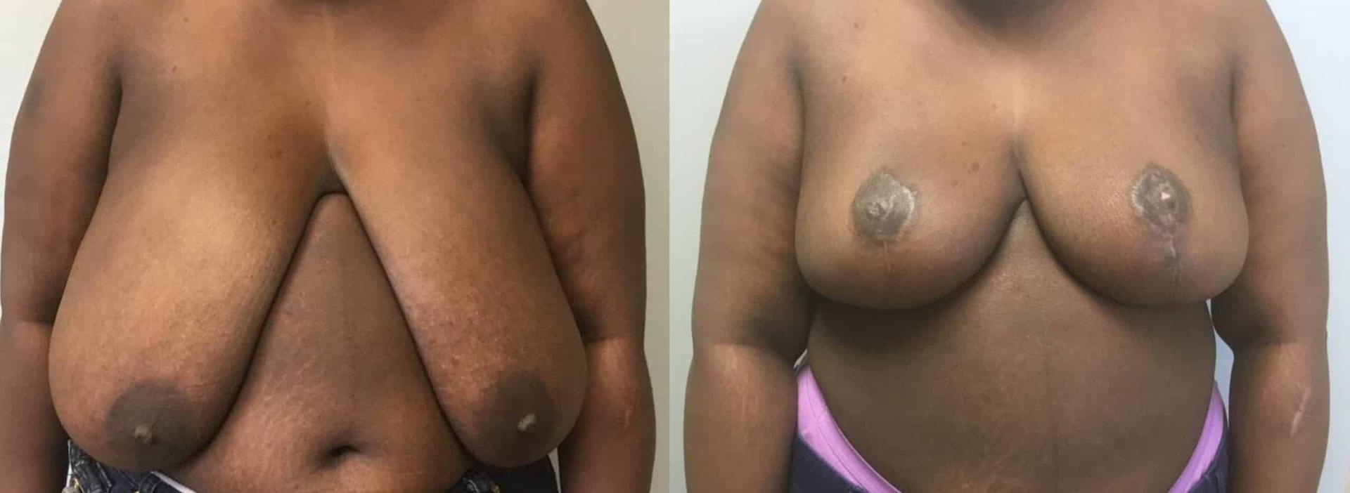 John Reilly MD Plastic Surgeon breast reduction result — Bedford, NH