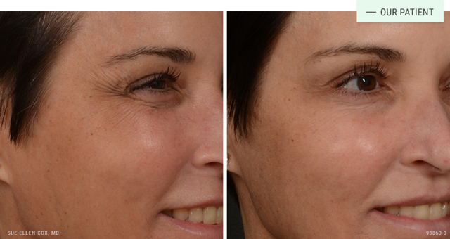 Botox result at Aesthetic Solutions in Chapel Hill, NC