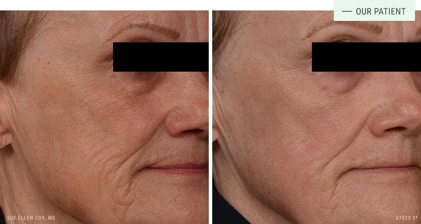 Aesthetic Solutions laser treatment result — Chapel Hill, NC