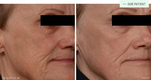 Microneedling result at Aesthetic Solutions in Chapel Hill, NC