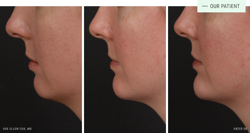 Aesthetic Solutions result — Chapel Hill, NC