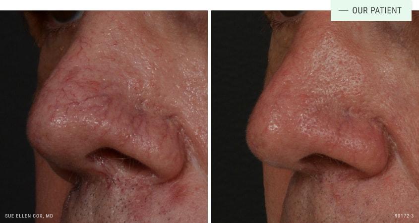 Aesthetic Solutions laser treatment result — Chapel Hill, NC