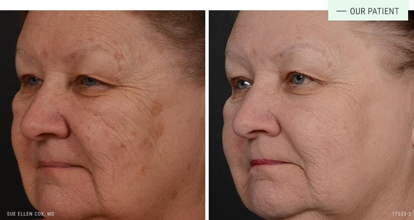 Aesthetic Solutions laser treatment result — Chapel Hill, NC