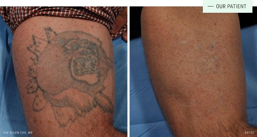 Aesthetic Solutions laser treatment result — Chapel Hill, NC