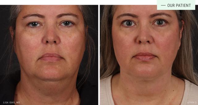 Deep Plane Facelift result at Aesthetic Solutions in Chapel Hill, NC