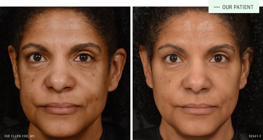 Aesthetic Solutions result — Chapel Hill, NC