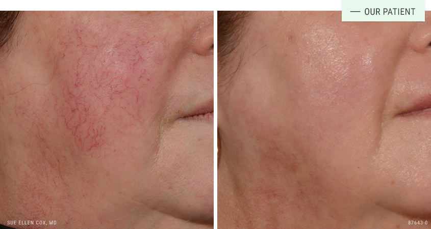Aesthetic Solutions result — Chapel Hill, NC
