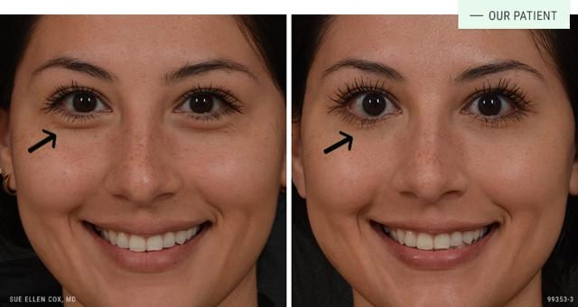 Botox result at Aesthetic Solutions in Chapel Hill, NC