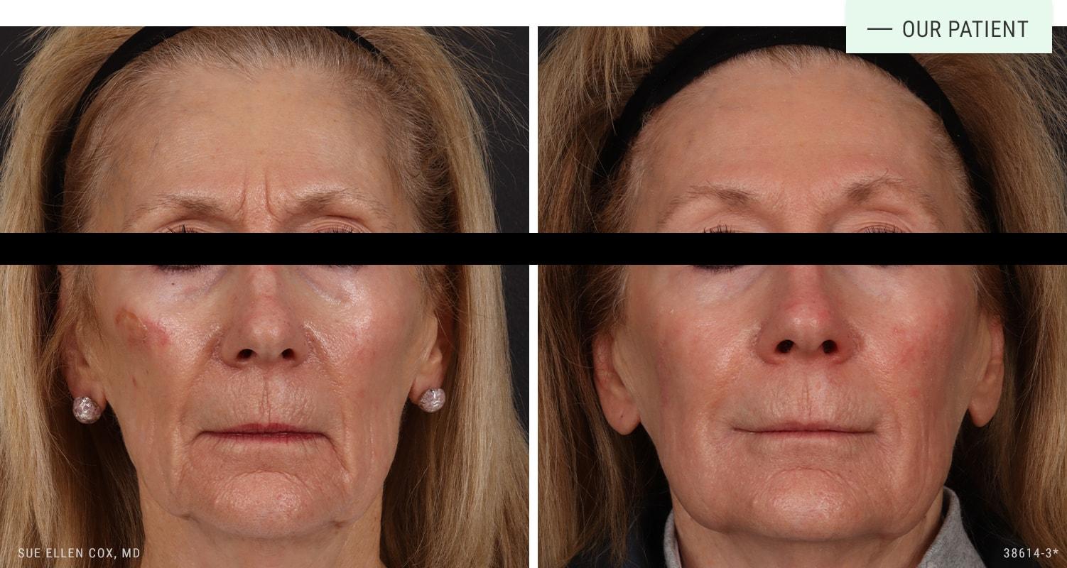 Aesthetic Solutions cheek filler result — Chapel Hill, NC