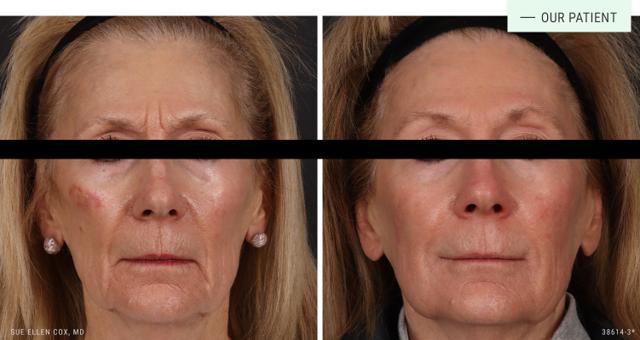 Dermal Fillers result at Aesthetic Solutions in Chapel Hill, NC