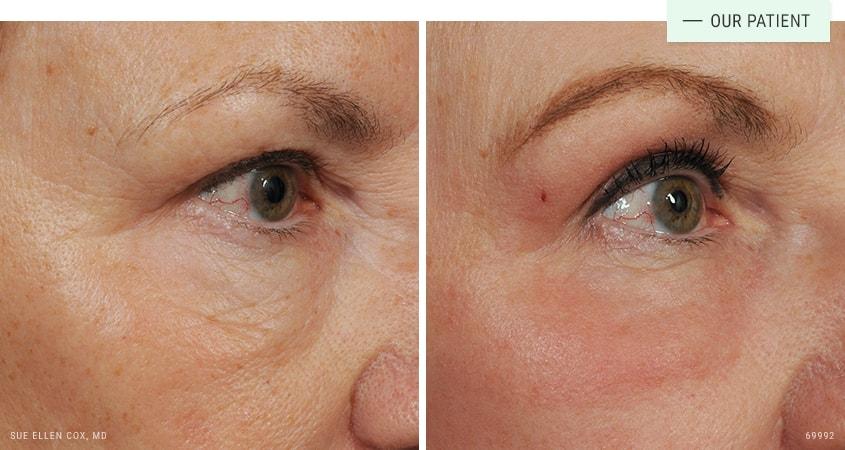Aesthetic Solutions laser treatment result — Chapel Hill, NC