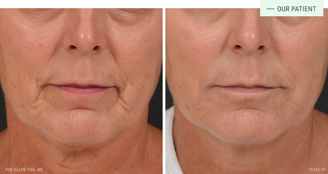 Deep Plane Facelift result at Aesthetic Solutions in Chapel Hill, NC