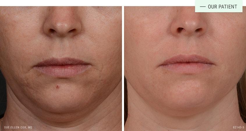 Aesthetic Solutions microneedling result — Chapel Hill, NC