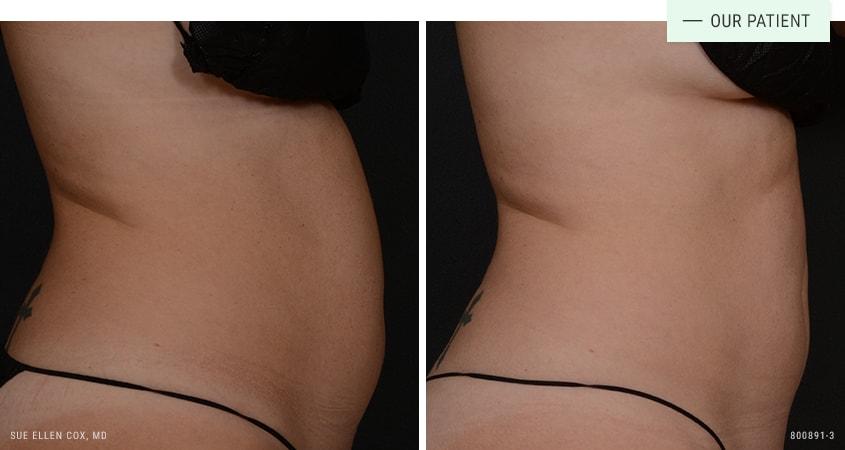 Aesthetic Solutions emsculpt result — Chapel Hill, NC