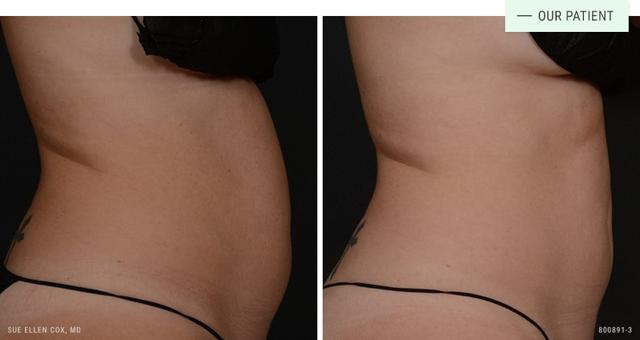 Thigh Lift result at Aesthetic Solutions in Chapel Hill, NC