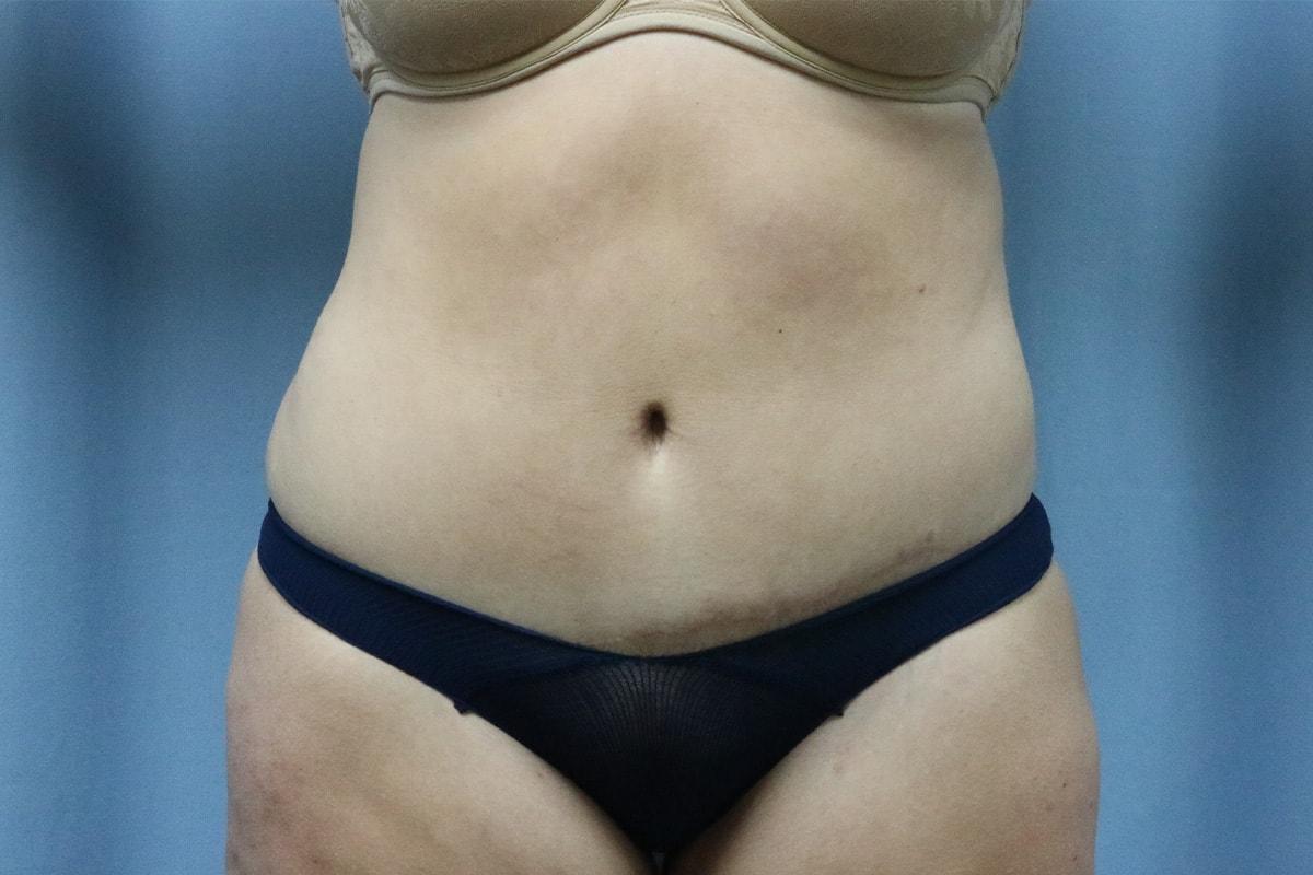 James B. Depew, MD tummy tuck after — Atlanta, GA
