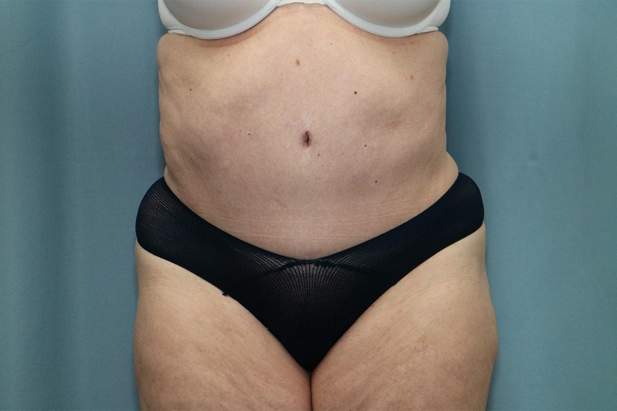 James B. Depew, MD tummy tuck after — Atlanta, GA