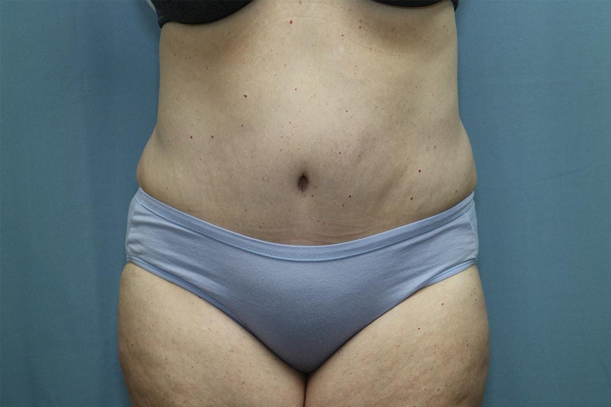James B. Depew, MD tummy tuck after — Atlanta, GA