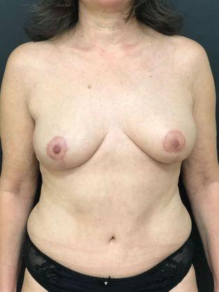 Oren Z. Lerman, MD breast lift after — White Plains, NY
