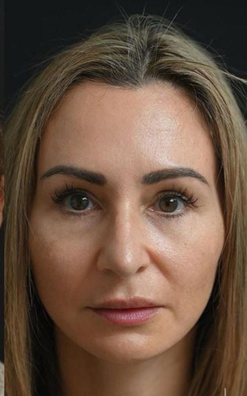 Roseville Facial Plastic Surgery facelift after — Roseville, CA