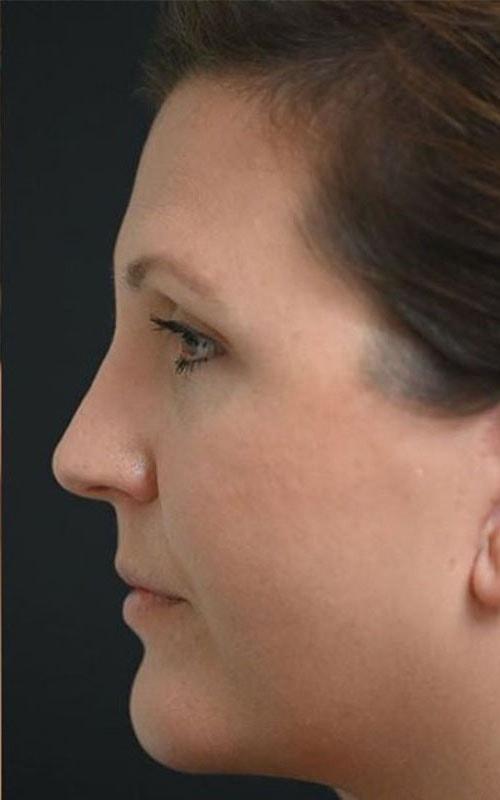 Roseville Facial Plastic Surgery facelift after — Roseville, CA