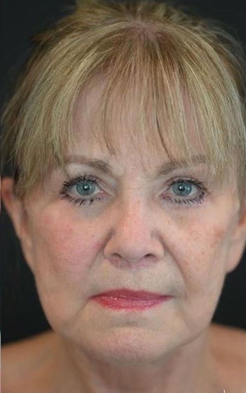 Roseville Facial Plastic Surgery facelift after — Roseville, CA