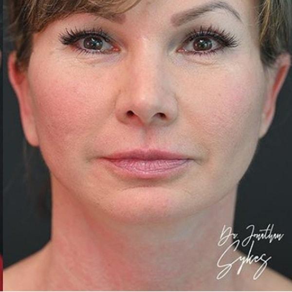 Roseville Facial Plastic Surgery neck lift after — Roseville, CA