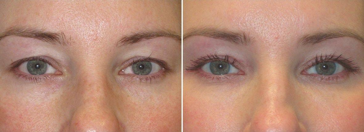 Warren C. Stout, MD eyelid lift result — Pasadena, CA