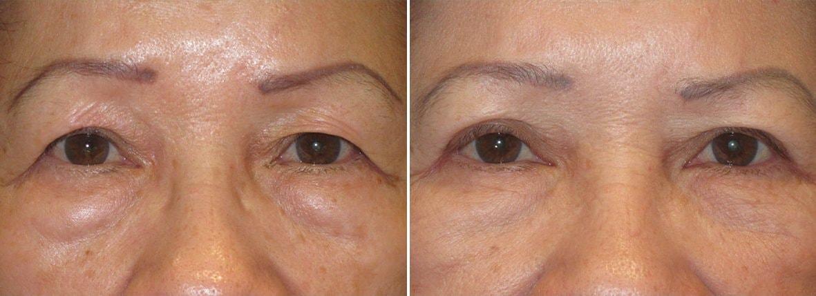 Warren C. Stout, MD eyelid lift result — Pasadena, CA