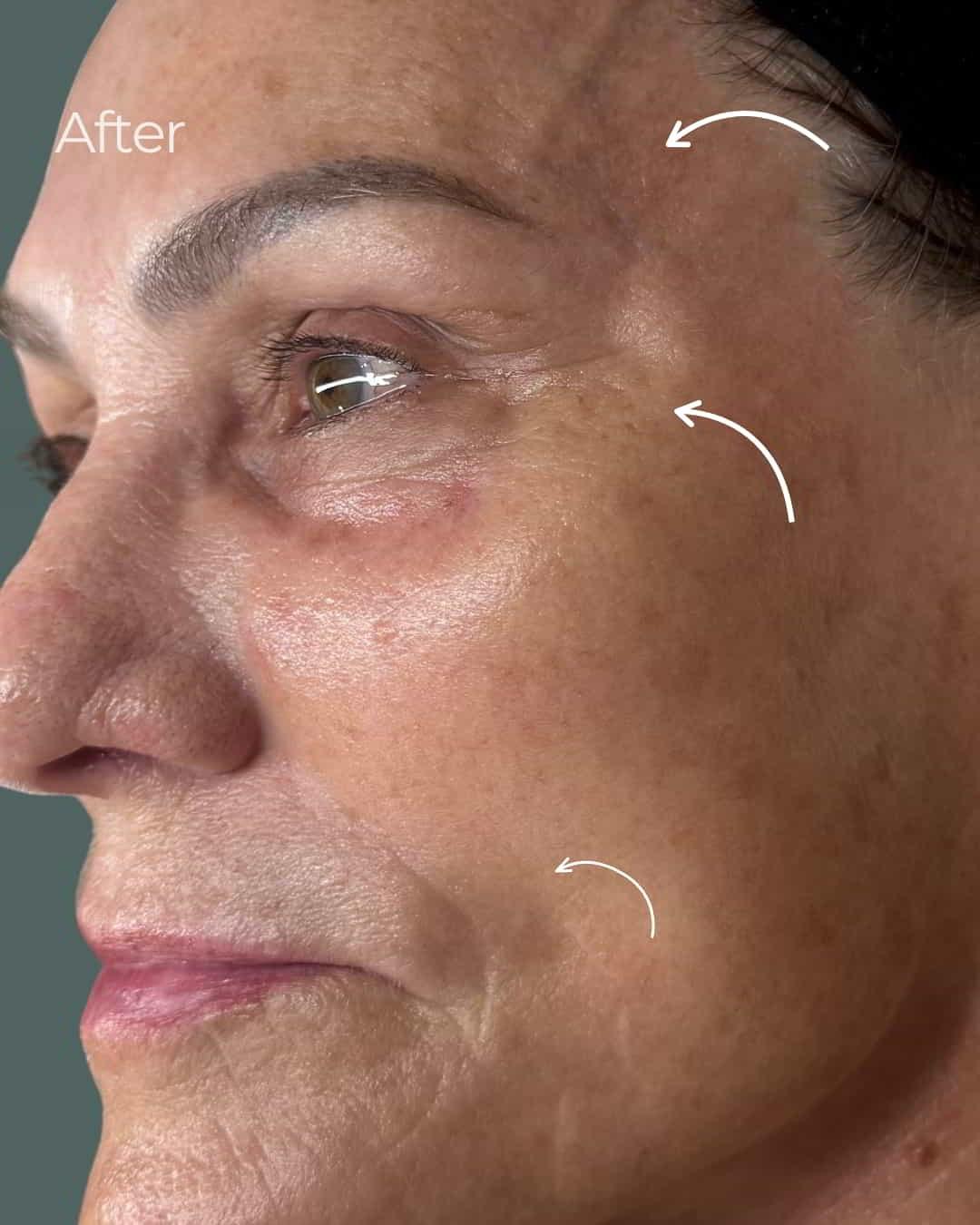 ReSpa Palm Beach chemical peel after — Palm Beach Gardens, FL