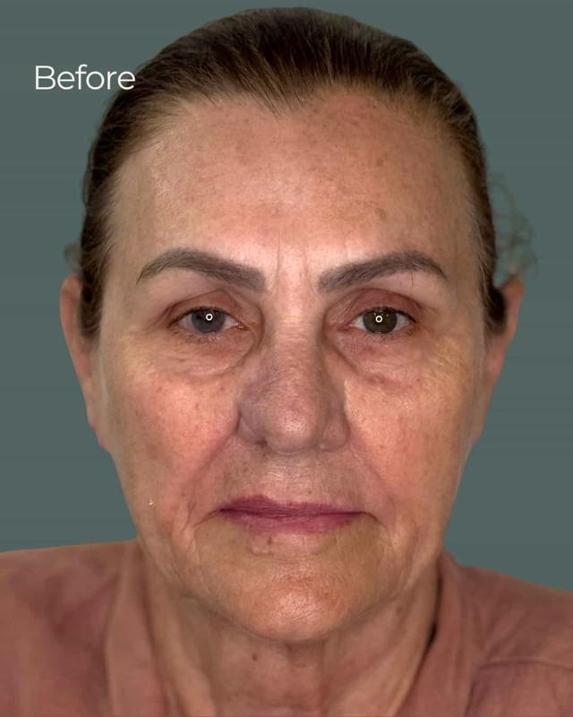 Chemical Peel before at ReSpa Palm Beach in Palm Beach Gardens, FL