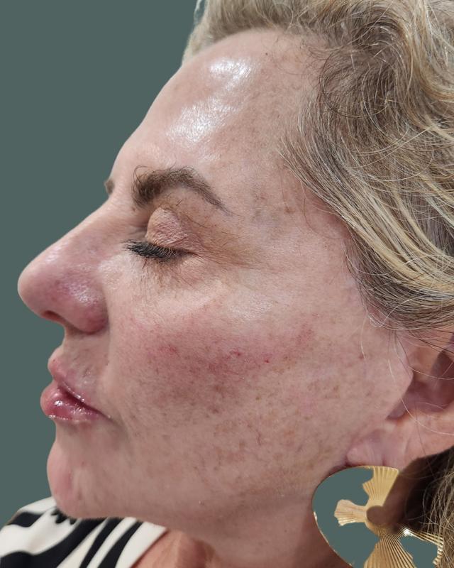 Juvederm after at ReSpa Palm Beach in Palm Beach Gardens, FL