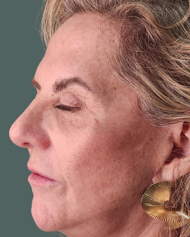 Juvederm before at ReSpa Palm Beach in Palm Beach Gardens, FL