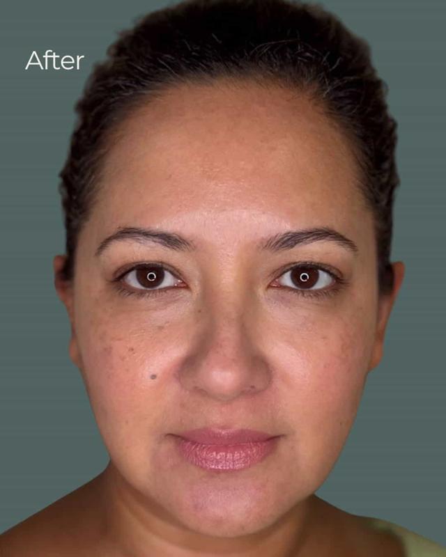 Chemical Peel after at ReSpa Palm Beach in Palm Beach Gardens, FL