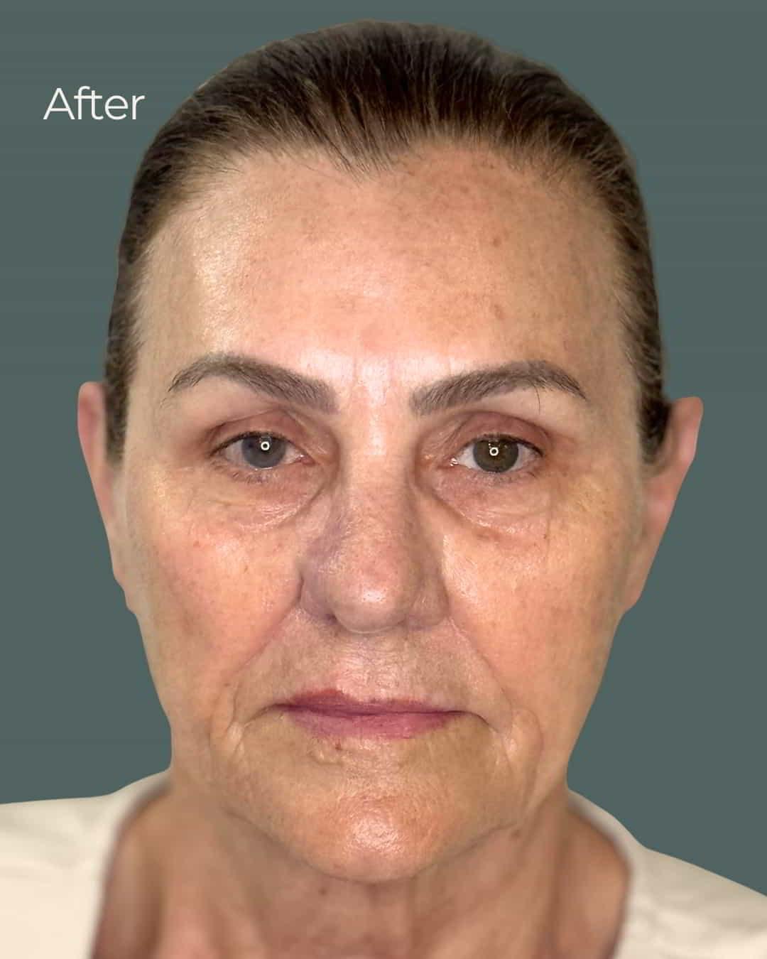 ReSpa Palm Beach chemical peel after — Palm Beach Gardens, FL