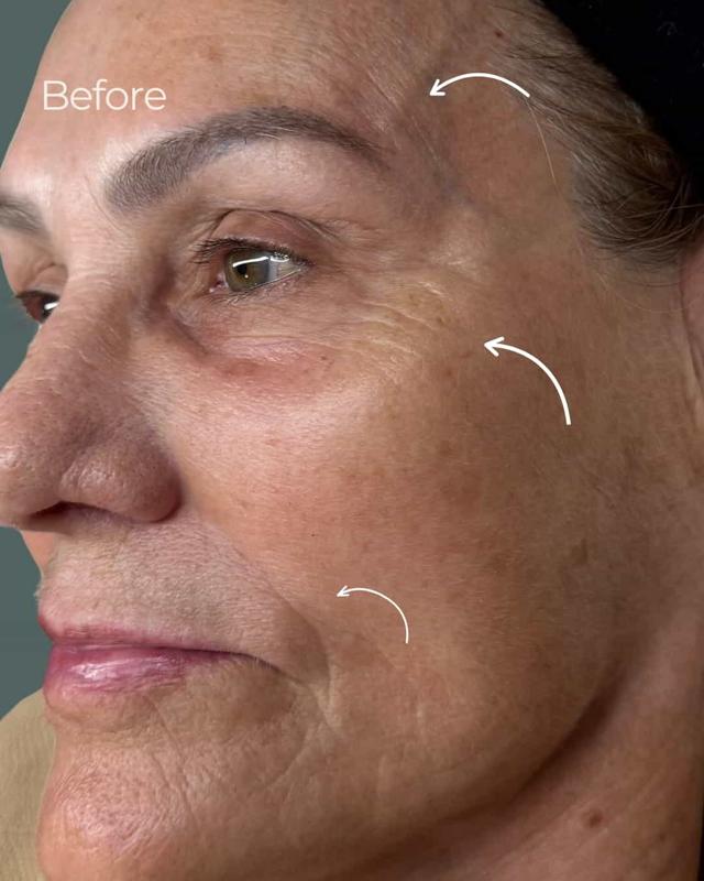 Chemical Peel before at ReSpa Palm Beach in Palm Beach Gardens, FL