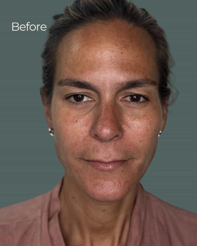 Chemical Peel before at ReSpa Palm Beach in Palm Beach Gardens, FL