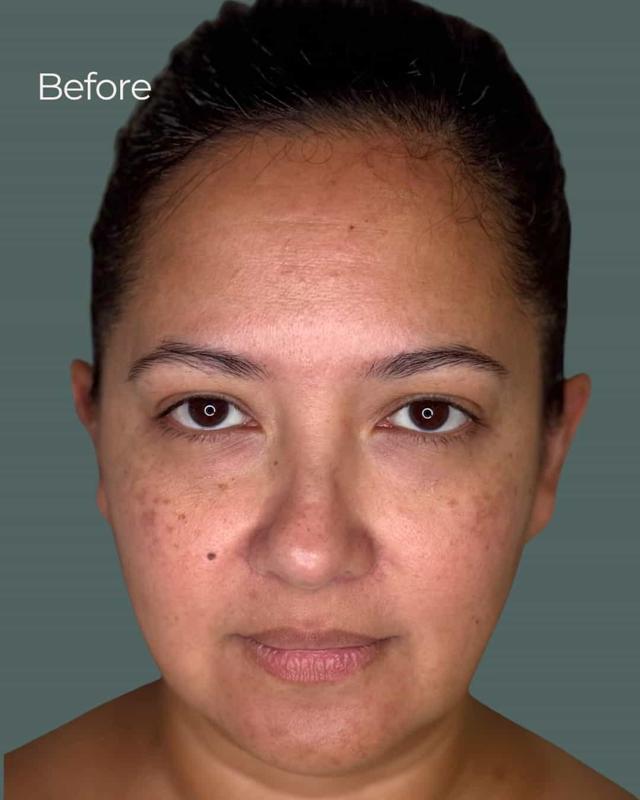 Chemical Peel before at ReSpa Palm Beach in Palm Beach Gardens, FL