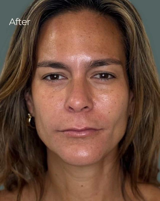 Chemical Peel after at ReSpa Palm Beach in Palm Beach Gardens, FL