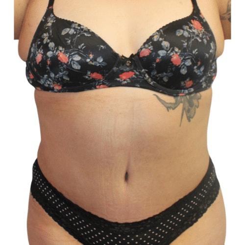 Estea Cosmetic tummy tuck after — Long Beach, CA
