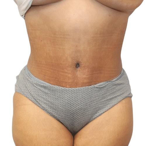 Estea Cosmetic tummy tuck after — Long Beach, CA