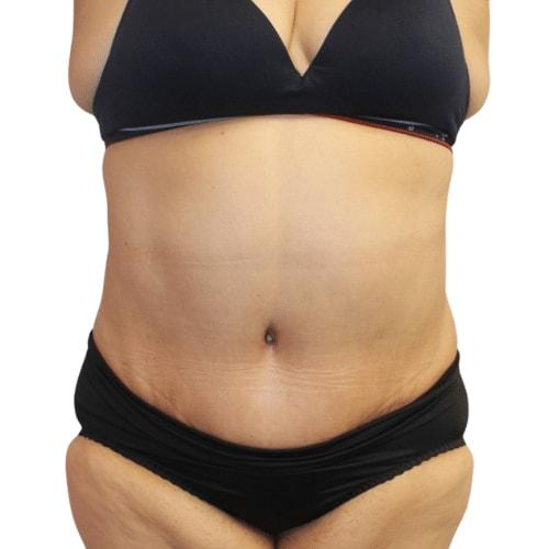Estea Cosmetic tummy tuck after — Long Beach, CA
