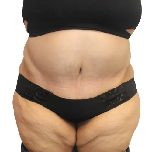 Estea Cosmetic tummy tuck after — Long Beach, CA