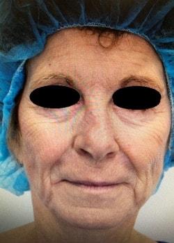 Fat Transfer before at Estea Cosmetic in Long Beach, CA
