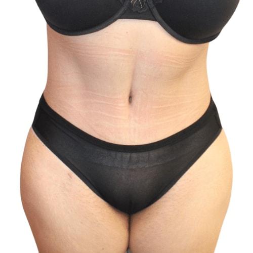 Estea Cosmetic tummy tuck after — Long Beach, CA