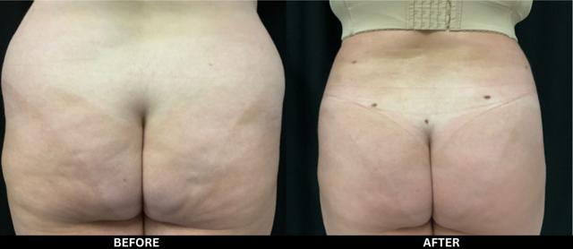 Brazilian Butt Lift result at Zinnia Aesthetics and Anti-Aging Clinic in Fairfax, VA