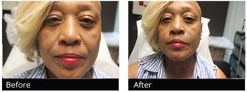 Zinnia Aesthetics and Anti-Aging Clinic result — Fairfax, VA