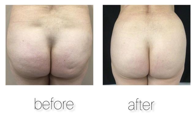 Brazilian Butt Lift result at Zinnia Aesthetics and Anti-Aging Clinic in Fairfax, VA